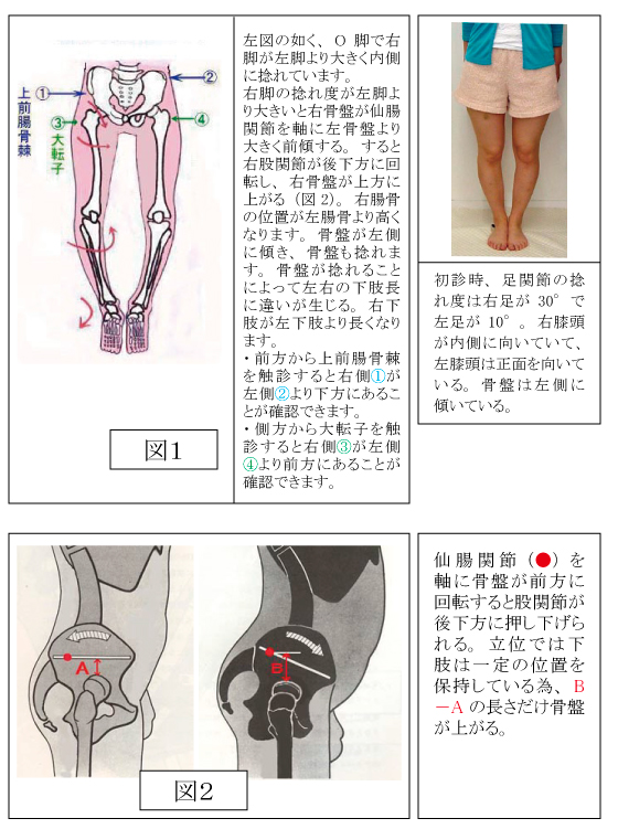 ・ 両脚(膝の間)が同じように開いている場合