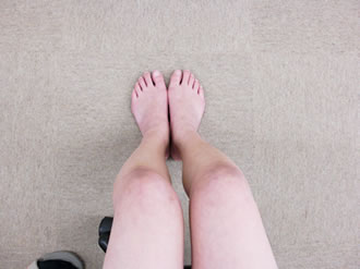 自己診断用写真